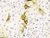 Células de melanoma 