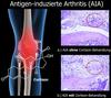Wie Cortison bei der Behandlung von Rheumatoider Arthritis wirkt