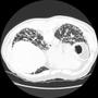 CT scan