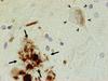 Früher Hinweis auf die Alzheimer-Erkrankung
