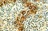 Developmental protein plays role in spread of cancer